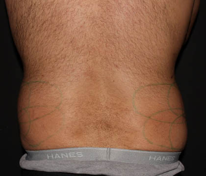 gilbertmedspa - Before Treatment
