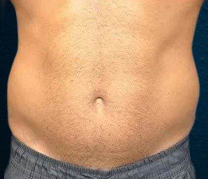 gilbertmedspa - Before Treatment