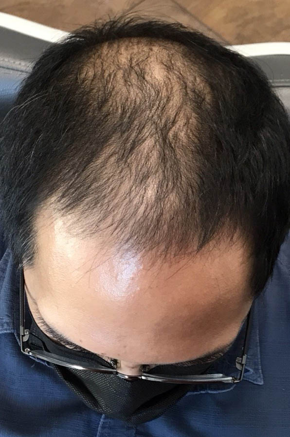 gilbertmedspa - Before Treatment