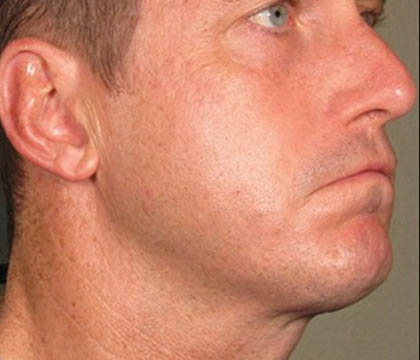 gilbertmedspa - Before Treatment