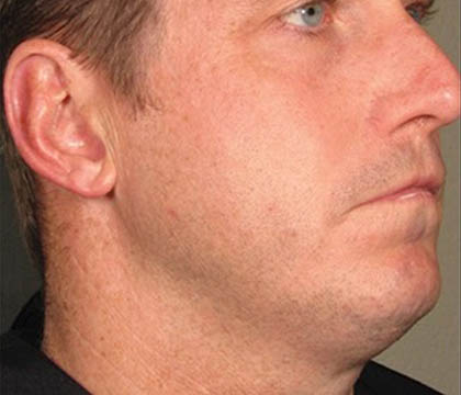gilbertmedspa - Before Treatment