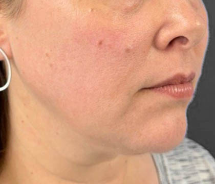 gilbertmedspa - Before Treatment