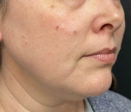 gilbertmedspa - Before Treatment